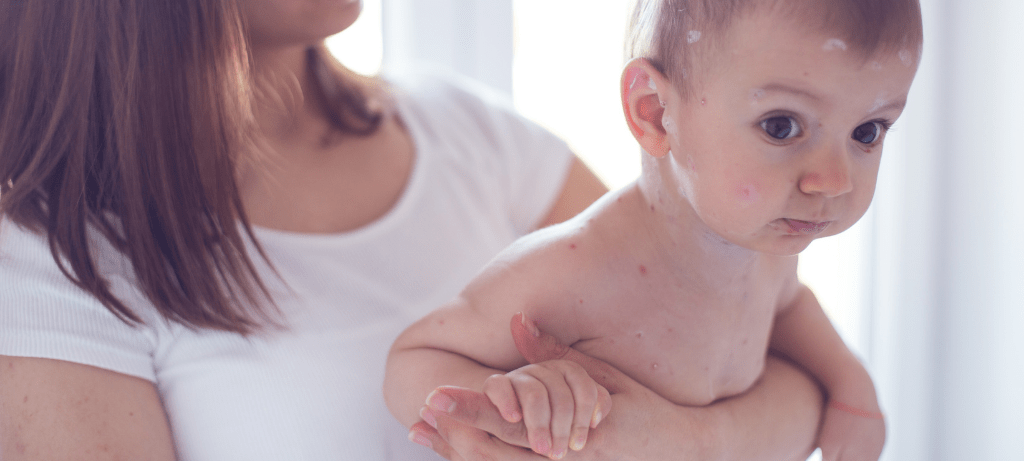 chickenpox vaccine wellingborough